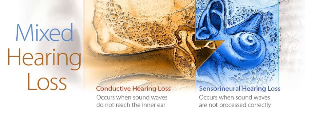 Mixed Hearing Loss Chico Ca Ns Audiological Services
